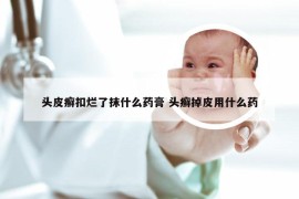 头皮癣扣烂了抹什么药膏 头癣掉皮用什么药