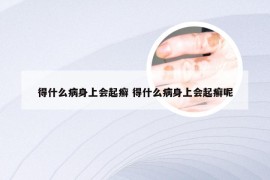 得什么病身上会起癣 得什么病身上会起癣呢