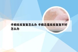 手癣反反复复怎么办 手癣总是反反复复不好怎么办