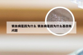 银血病是因为什么 银血病是因为什么基因有问题