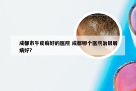 成都市牛皮癣好的医院 成都哪个医院治银屑病好?