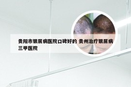 贵阳市银屑病医院口碑好的 贵州治疗银屑病三甲医院