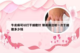 牛皮癣可以打干细胞针 银屑病注射一次干细胞多少钱