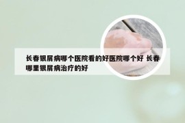 长春银屑病哪个医院看的好医院哪个好 长春哪里银屑病治疗的好