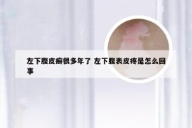 左下腹皮癣很多年了 左下腹表皮疼是怎么回事