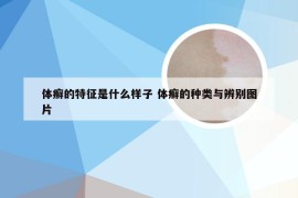 体癣的特征是什么样子 体癣的种类与辨别图片