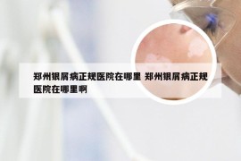 郑州银屑病正规医院在哪里 郑州银屑病正规医院在哪里啊