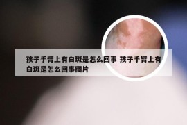 孩子手臂上有白斑是怎么回事 孩子手臂上有白斑是怎么回事图片