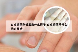 白点癫风刚长出来什么样子 白点癫风从什么地方开始