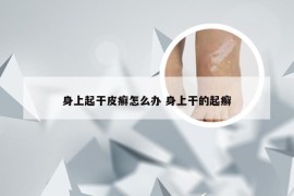 身上起干皮癣怎么办 身上干的起癣