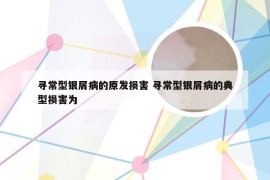 寻常型银屑病的原发损害 寻常型银屑病的典型损害为