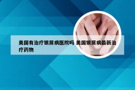 美国有治疗银屑病医院吗 美国银屑病最新治疗药物