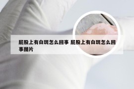 屁股上有白斑怎么回事 屁股上有白斑怎么回事图片