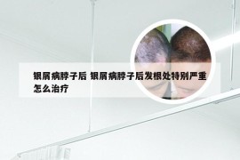 银屑病脖子后 银屑病脖子后发根处特别严重怎么治疗