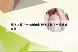 脖子上长了一片癣掉皮 脖子上长了一片癣掉皮屑