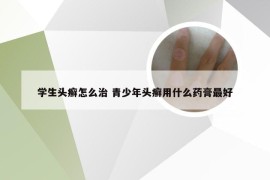 学生头癣怎么治 青少年头癣用什么药膏最好