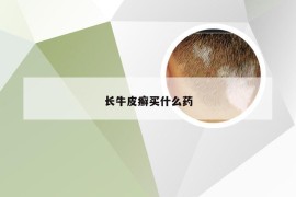 长牛皮癣买什么药