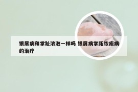 银屑病和掌趾浓泡一样吗 银屑病掌跖脓疱病的治疗