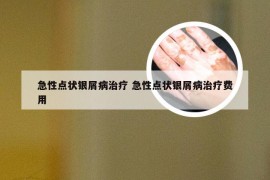 急性点状银屑病治疗 急性点状银屑病治疗费用