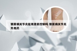 银屑病关节炎能用激素控制吗 银屑病关节炎外用药