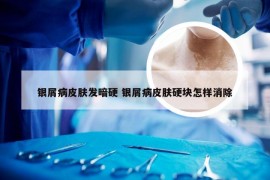 银屑病皮肤发暗硬 银屑病皮肤硬块怎样消除