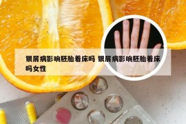 银屑病影响胚胎着床吗 银屑病影响胚胎着床吗女性