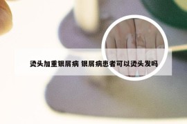 烫头加重银屑病 银屑病患者可以烫头发吗