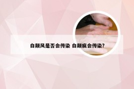 白颠风是否会传染 白颠疯会传染?