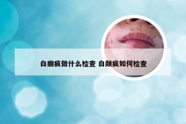 白癫疯做什么检查 白颠疯如何检查