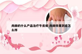 尚赫的什么产品治疗牛皮癣 尚赫效果到底怎么样