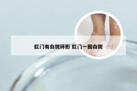 肛门有白斑环形 肛门一圈白斑