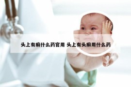 头上有癣什么药官用 头上有头癣用什么药