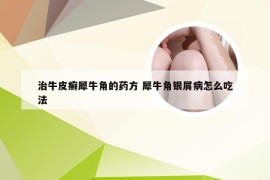 治牛皮癣犀牛角的药方 犀牛角银屑病怎么吃法