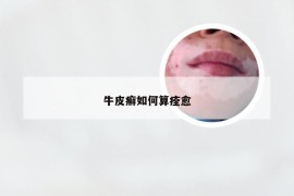 牛皮癣如何算痊愈