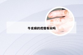 牛皮癣的疙瘩有尖吗