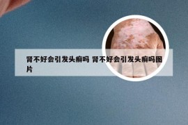 肾不好会引发头癣吗 肾不好会引发头癣吗图片