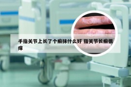 手指关节上长了个癣抹什么好 指关节长癣很痒