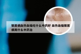 银屑病血热血燥吃什么中药好 血热血燥银屑病用什么中药治