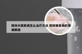 斑块大银屑病怎么治疗方法 斑块银屑病的发病原因