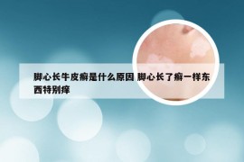 脚心长牛皮癣是什么原因 脚心长了癣一样东西特别痒