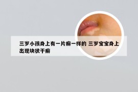 三岁小孩身上有一片癣一样的 三岁宝宝身上出现块状干癣