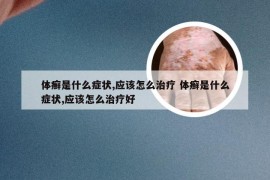 体癣是什么症状,应该怎么治疗 体癣是什么症状,应该怎么治疗好