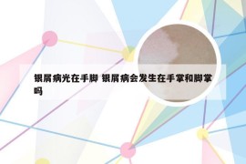 银屑病光在手脚 银屑病会发生在手掌和脚掌吗