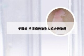 手湿癣 手湿癣传染别人吗会传染吗