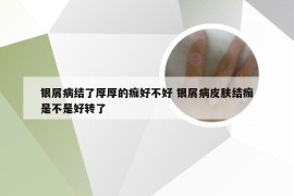 银屑病结了厚厚的痂好不好 银屑病皮肤结痂是不是好转了