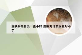 皮肤癣为什么一直不好 皮癣为什么反复好不了