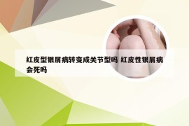 红皮型银屑病转变成关节型吗 红皮性银屑病会死吗