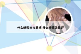 什么糖浆治皮肤病 什么糖浆效果好