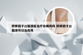 转移因子口服液能治疗白癜风吗 转移因子口服液可以治白风