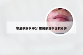 银屑病皮损评分 银屑病皮损面积计算